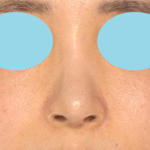 「鼻孔縁下降術」　新宿ラクル美容外科クリニック　山本厚志　２０代女性　手術後１２ヶ月目　７月１３日