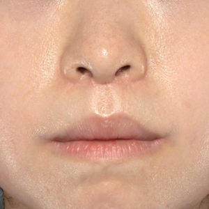 新宿ラクル美容外科クリニック　山本厚志　「口角挙上（スマイルリップ）+ 人中短縮術（リップリフト）」　手術後１２ヶ月目　５月１５日