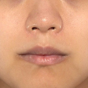 新宿ラクル美容外科クリニック　山本厚志　「貴族手術（鼻翼基部プロテーゼ）＋ 小鼻縮小+α法 ＋ 口角挙上」　手術後１２ヶ月目　６月６日