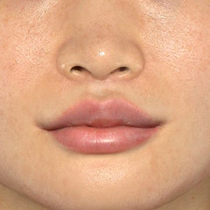 新宿ラクル美容外科クリニック　山本厚志　「人中短縮術（リップリフト）＋口角挙上（スマイルリップ）」　手術後３ヶ月目　１２月７日