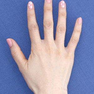 新宿ラクル美容外科クリニック　山本厚志　「手の若返り（プレミアムPRP×FGF皮膚再生療法）」　治療後３ヶ月目　４月１９日