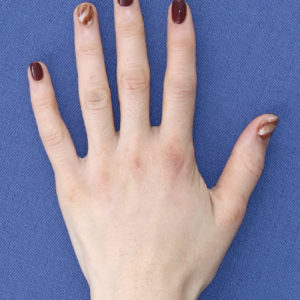 新宿ラクル美容外科クリニック　山本厚志　「手の若返り（プレミアムPRP×FGF皮膚再生療法）」　治療直後　１１月２１日