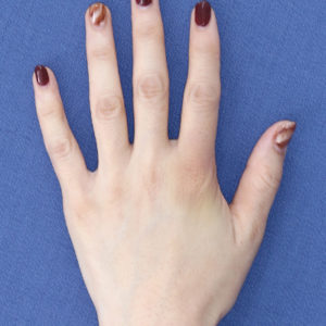 新宿ラクル美容外科クリニック　山本厚志　「手の若返り（プレミアムPRP×FGF皮膚再生療法）」　治療後１週間目　１１月２１日