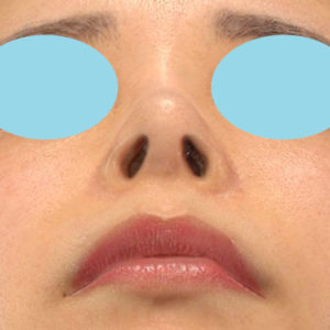 「鼻孔縁下降術」　新宿ラクル美容外科クリニック　山本厚志　２０代女性　手術後１２ヶ月目　７月１３日