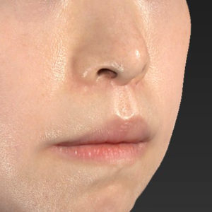 新宿ラクル美容外科クリニック　山本厚志　「口角挙上（スマイルリップ）+ 人中短縮術（リップリフト）」　手術後１２ヶ月目　５月１５日