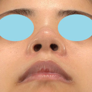 新宿ラクル美容外科クリニック　山本厚志　「貴族手術（鼻翼基部プロテーゼ）＋ 小鼻縮小+α法 ＋ 口角挙上」　手術後１２ヶ月目　６月６日