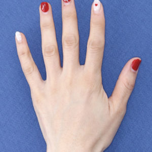 新宿ラクル美容外科クリニック　山本厚志　「手の若返り（プレミアムPRP×FGF皮膚再生療法）」　治療後１ヶ月目　１１月２１日