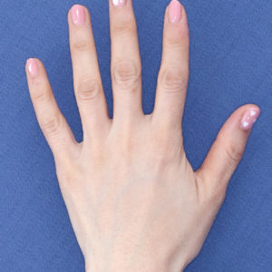 新宿ラクル美容外科クリニック　山本厚志　「手の若返り（プレミアムPRP×FGF皮膚再生療法）」　治療後３ヶ月目　４月１９日