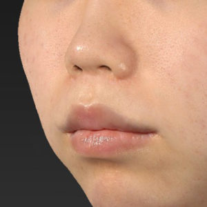 新宿ラクル美容外科クリニック　山本厚志　「人中短縮術（リップリフト）＋口角挙上（スマイルリップ）」　手術後１２ヶ月目　５月２日