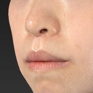 新宿ラクル美容外科クリニック　山本厚志　「口角挙上（スマイルリップ）+ 人中短縮術（リップリフト）」　手術後１２ヶ月目　５月１５日