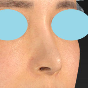「鼻孔縁下降術」　新宿ラクル美容外科クリニック　山本厚志　２０代女性　手術後１２ヶ月目　７月１３日