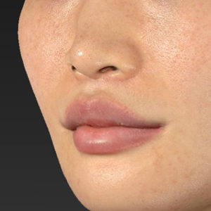 新宿ラクル美容外科クリニック　山本厚志　「人中短縮術（リップリフト）＋口角挙上（スマイルリップ）」　手術後３ヶ月目　１２月７日