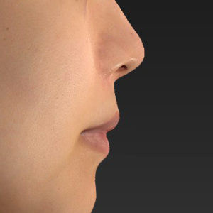 新宿ラクル美容外科クリニック　山本厚志　「貴族手術（鼻翼基部プロテーゼ）＋ 小鼻縮小+α法 ＋ 口角挙上」　手術後１２ヶ月目　６月６日