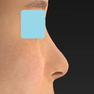 「鼻孔縁下降術」　新宿ラクル美容外科クリニック　山本厚志　２０代女性　手術後１２ヶ月目　７月１３日