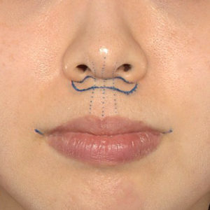 新宿ラクル美容外科クリニック　山本厚志　「人中短縮術（リップリフト）＋口角挙上（スマイルリップ）」　デザイン　１２月２７日