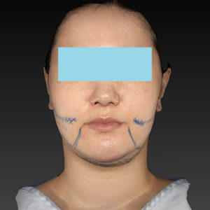 新宿ラクル美容外科クリニック　山本厚志　「ナチュラルフェイスネックリフト」「ライポライフ脂肪吸引（ジョールファット+あご下）」　デザイン　１月２日