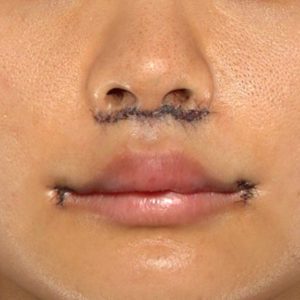 新宿ラクル美容外科クリニック　山本厚志　「人中短縮術（リップリフト）＋口角挙上（スマイルリップ）」　手術直後　１２月２９日