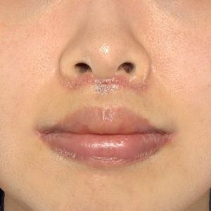 新宿ラクル美容外科クリニック　山本厚志　「人中短縮術（リップリフト）＋口角挙上（スマイルリップ）」　手術後１週間目　１２月２７日