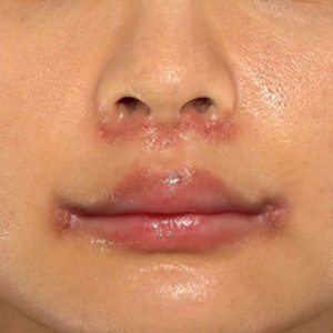 新宿ラクル美容外科クリニック　山本厚志　「人中短縮術（リップリフト）＋口角挙上（スマイルリップ）」　手術後１週間目　１２月２９日