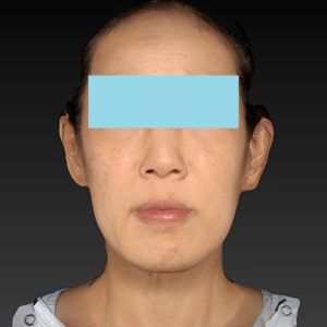 新宿ラクル美容外科クリニック　山本厚志　ナチュラルフェイスネックリフト　手術後１２ヶ月目　４月１日