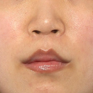 新宿ラクル美容外科クリニック　山本厚志　「人中短縮術（リップリフト）＋口角挙上（スマイルリップ）」　手術後１２ヶ月目　５月１７日