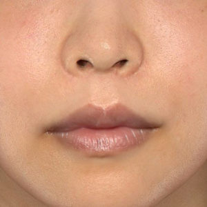 新宿ラクル美容外科クリニック　山本厚志　「人中短縮術（リップリフト）＋口角挙上（スマイルリップ）」　手術後１２ヶ月目　６月３日