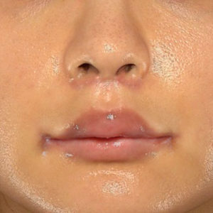 新宿ラクル美容外科クリニック　山本厚志　「人中短縮術（リップリフト）＋口角挙上（スマイルリップ）」　手術後１ヶ月目　１２月２９日