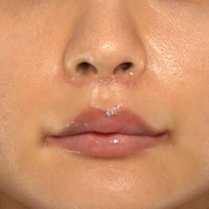 新宿ラクル美容外科クリニック　山本厚志　「人中短縮術（リップリフト）＋口角挙上（スマイルリップ）」　手術後２ヶ月目　１２月２９日