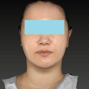 新宿ラクル美容外科クリニック　山本厚志　「ナチュラルフェイスネックリフト」「ライポライフ脂肪吸引（ジョールファット+あご下）」　手術後２ヶ月目　１月２日