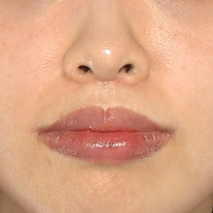 新宿ラクル美容外科クリニック　山本厚志　「人中短縮術（リップリフト）＋口角挙上（スマイルリップ）」　手術後２ヶ月目　１月２７日