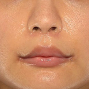 新宿ラクル美容外科クリニック　山本厚志　「人中短縮術（リップリフト）＋口角挙上（スマイルリップ）」　手術後３ヶ月目　１月２３日