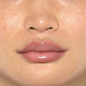 新宿ラクル美容外科クリニック　山本厚志　「人中短縮術（リップリフト）＋口角挙上（スマイルリップ）+小鼻縮小＋α法」　手術後６ヶ月目　３月２５日