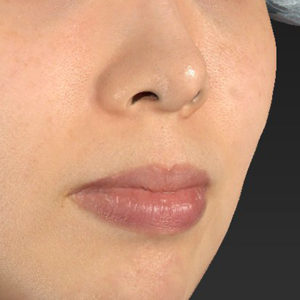 新宿ラクル美容外科クリニック　山本厚志　「人中短縮術（リップリフト）＋口角挙上（スマイルリップ）」　手術前　１２月２７日