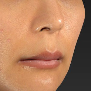 新宿ラクル美容外科クリニック　山本厚志　「人中短縮術（リップリフト）＋口角挙上（スマイルリップ）」　手術前　１２月２９日