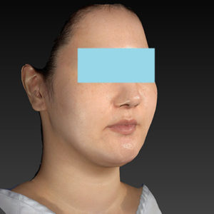 新宿ラクル美容外科クリニック　山本厚志　「ナチュラルフェイスネックリフト」「ライポライフ脂肪吸引（ジョールファット+あご下）」　手術前　１月２日