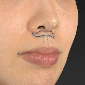 新宿ラクル美容外科クリニック　山本厚志　「人中短縮術（リップリフト）＋口角挙上（スマイルリップ）」　デザイン　１２月２７日