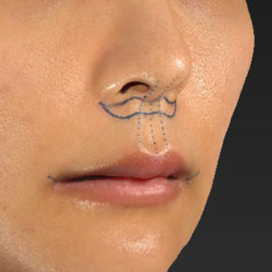 新宿ラクル美容外科クリニック　山本厚志　「人中短縮術（リップリフト）＋口角挙上（スマイルリップ）」　デザイン　１２月２９日