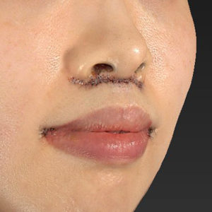 新宿ラクル美容外科クリニック　山本厚志　「人中短縮術（リップリフト）＋口角挙上（スマイルリップ）」　手術直後　１２月２７日