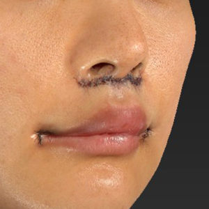 新宿ラクル美容外科クリニック　山本厚志　「人中短縮術（リップリフト）＋口角挙上（スマイルリップ）」　手術直後　１２月２９日