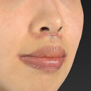 新宿ラクル美容外科クリニック　山本厚志　「人中短縮術（リップリフト）＋口角挙上（スマイルリップ）」　手術後１週間目　１２月２７日