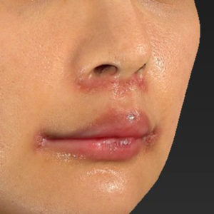新宿ラクル美容外科クリニック　山本厚志　「人中短縮術（リップリフト）＋口角挙上（スマイルリップ）」　手術後１週間目　１２月２９日