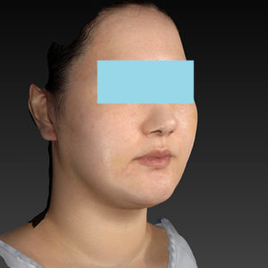 新宿ラクル美容外科クリニック　山本厚志　「ナチュラルフェイスネックリフト」「ライポライフ脂肪吸引（ジョールファット+あご下）」　手術後１週間目　１月２日