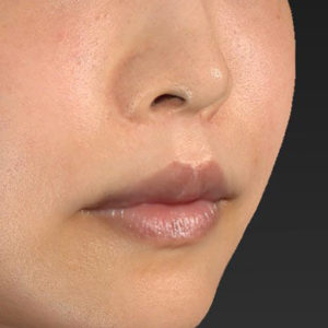 新宿ラクル美容外科クリニック　山本厚志　「人中短縮術（リップリフト）＋口角挙上（スマイルリップ）」　手術後１２ヶ月目　６月３日