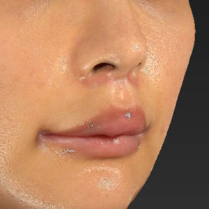 新宿ラクル美容外科クリニック　山本厚志　「人中短縮術（リップリフト）＋口角挙上（スマイルリップ）」　手術後１ヶ月目　１２月２９日