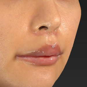 新宿ラクル美容外科クリニック　山本厚志　「人中短縮術（リップリフト）＋口角挙上（スマイルリップ）」　手術後２ヶ月目　１２月２９日