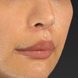 新宿ラクル美容外科クリニック　山本厚志　「人中短縮術（リップリフト）＋口角挙上（スマイルリップ）」　手術後３ヶ月目　１月２３日