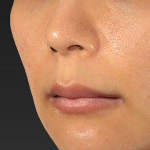 新宿ラクル美容外科クリニック　山本厚志　「人中短縮術（リップリフト）＋口角挙上（スマイルリップ）」　手術前　１２月２９日