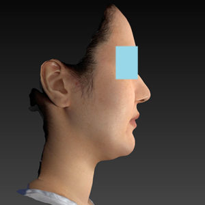 新宿ラクル美容外科クリニック　山本厚志　「ナチュラルフェイスネックリフト」「ライポライフ脂肪吸引（ジョールファット+あご下）」　手術前　１月２日