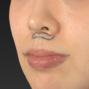 新宿ラクル美容外科クリニック　山本厚志　「人中短縮術（リップリフト）＋口角挙上（スマイルリップ）」　デザイン　１２月２７日