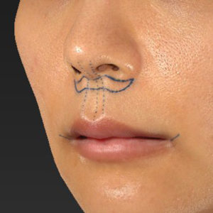 新宿ラクル美容外科クリニック　山本厚志　「人中短縮術（リップリフト）＋口角挙上（スマイルリップ）」　デザイン　１２月２９日